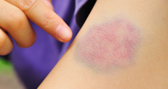 Muscle contusions
