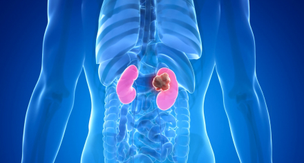 Image representing Understanding Kidney Tumours: Types, Diagnosis, and Treatment Options