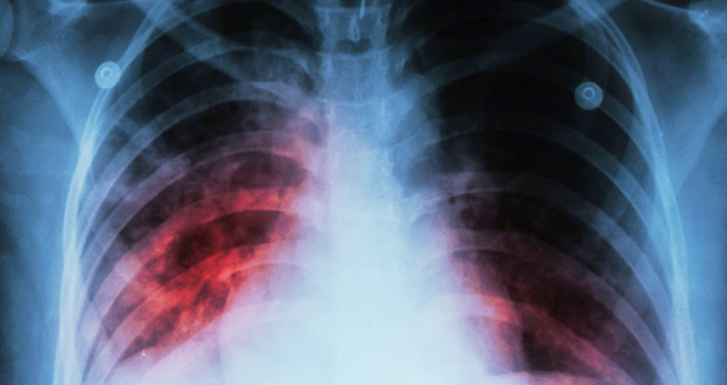 tuberculosis