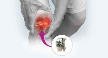 Image representing Robotic Total Knee Replacement Packages