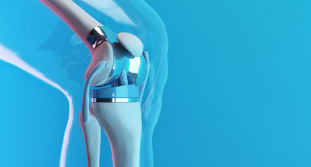 Image representing Robotic Assisted Surgery (ROSA) for Total Knee Replacement