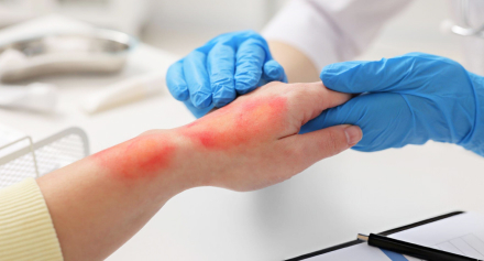 Image representing Understanding Burn Injuries During Ramadan: Prevention Tips and How Avisena Can Help