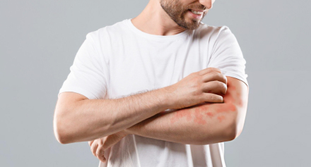 Image representing Understanding Psoriasis: Causes, Triggers and Modern Treatment Approaches